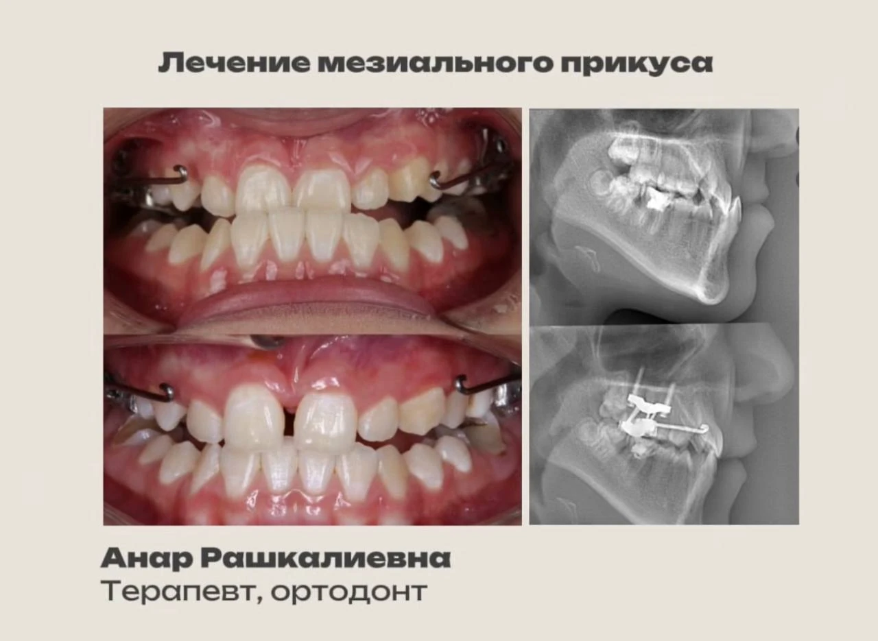 Фотоколлаж этапов лечения прикуса и рентгеновских снимков