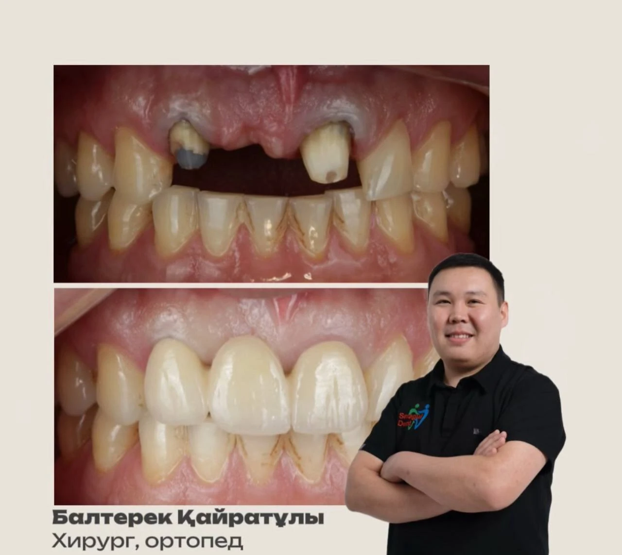 Фотоколлаж зубов до и после ортопедического восстановления