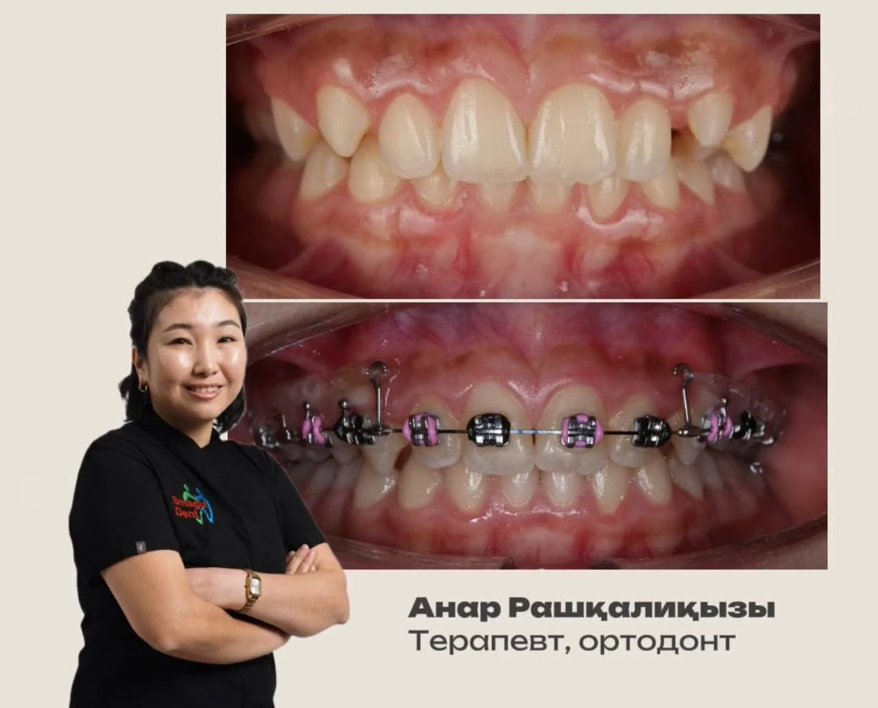 Фотоколлаж до лечения и во время лечения на брекет-системе